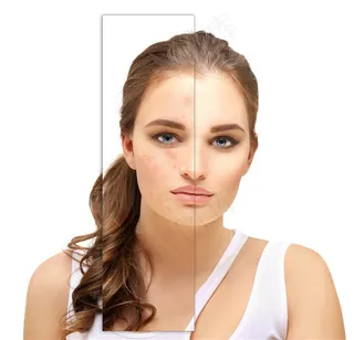 青春痘修复效果高清图片