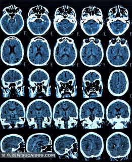 头部X光片医疗透视背景