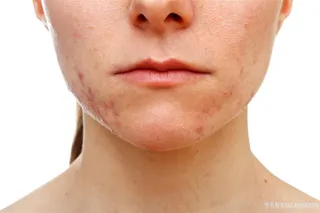 青春痘少女脸部特写高清图