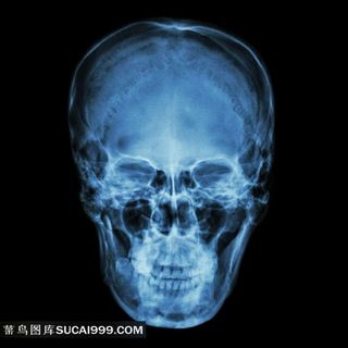 颅骨X光片图片