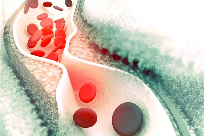 血小板堵塞高清图片