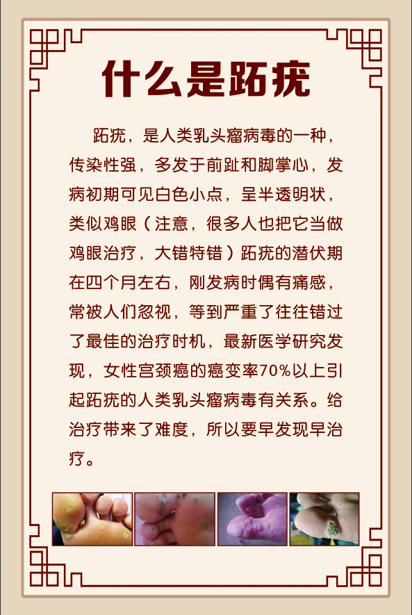 什么是跖疣psd模版下载