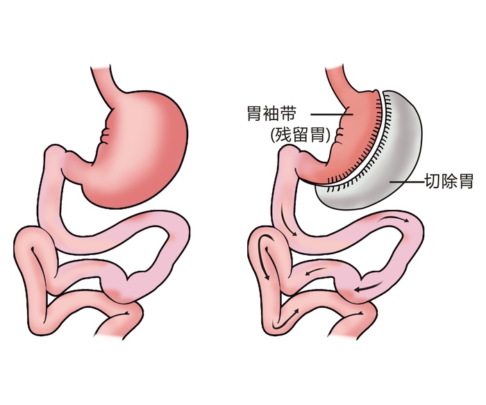 胃部病灶示意图4