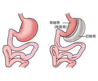 胃部病灶示意图4