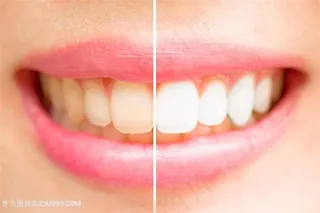 带牙套的美女高清图片