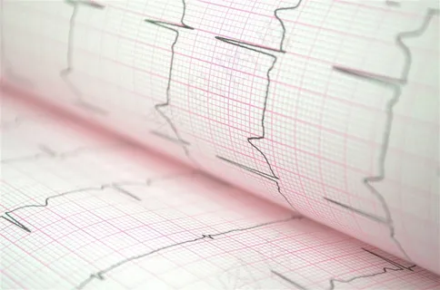 心电图检查结果高清图片