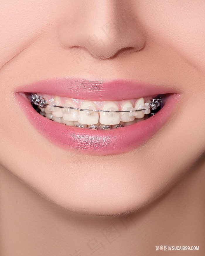 完美微笑箍牙牙科牙齿牙套图片