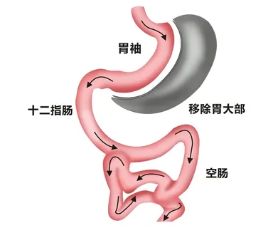 胃部病灶示意图1