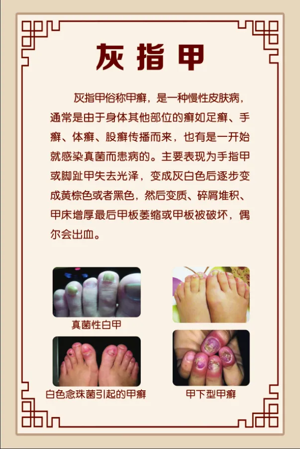 灰指甲展板psd模版下载