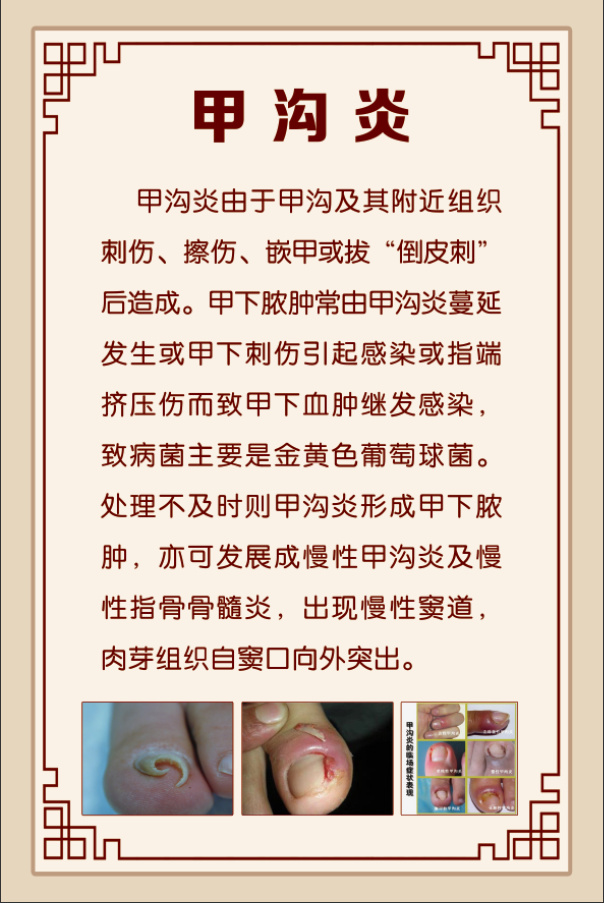 甲沟炎展板psd模版下载