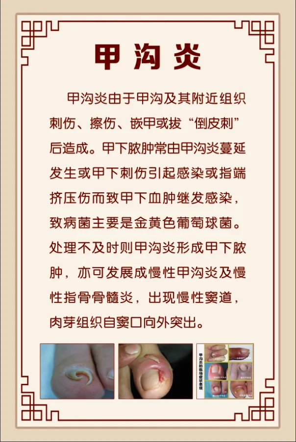 甲沟炎展板psd模版下载