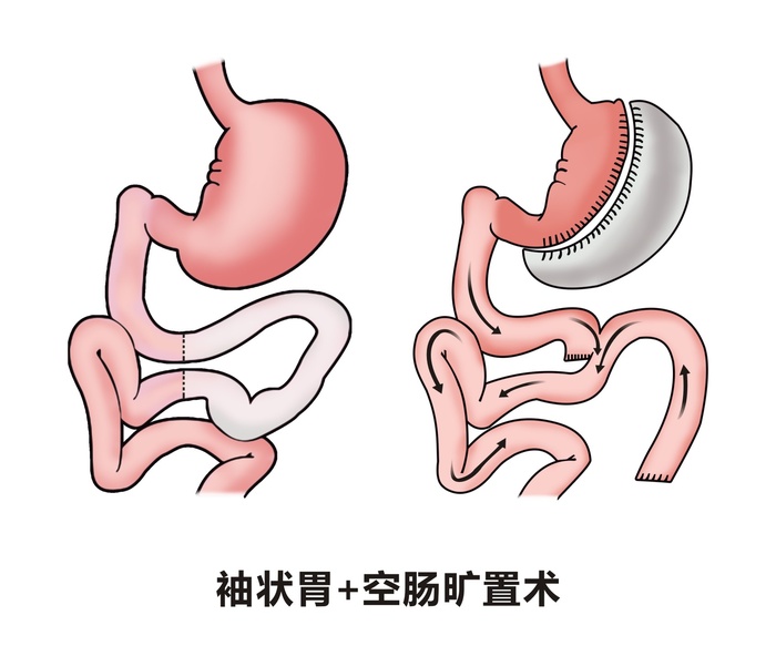 胃部病灶示意图3