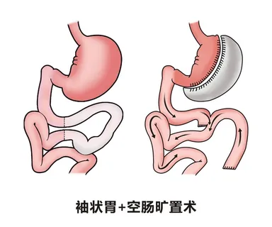 胃部病灶示意图3