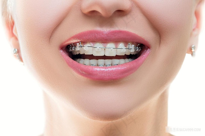 高清牙科牙齿牙套箍牙图片