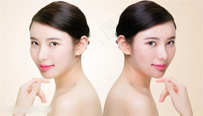痘痘肌皮肤对比照美容图片