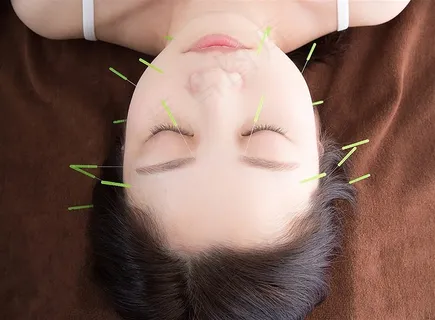 美女养生针灸高清图
