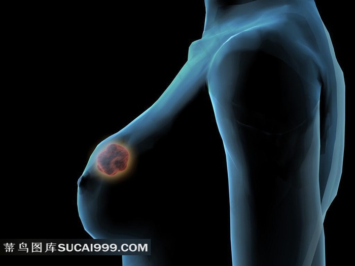 女人乳腺瘤透视图