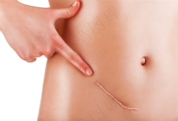 手指着腹部疤痕的女士高清图片