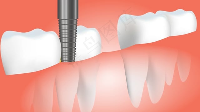 牙桥, 医疗的, 牙科, 桥, 牙医, 健康, 关心, 齿