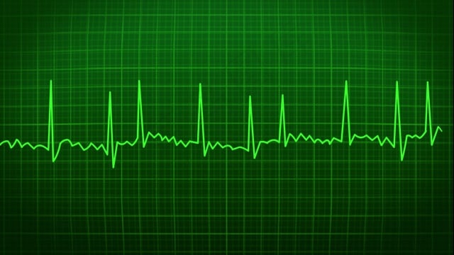 心电图, 心跳, 心, 颤动, 心房, 医疗的, 健康