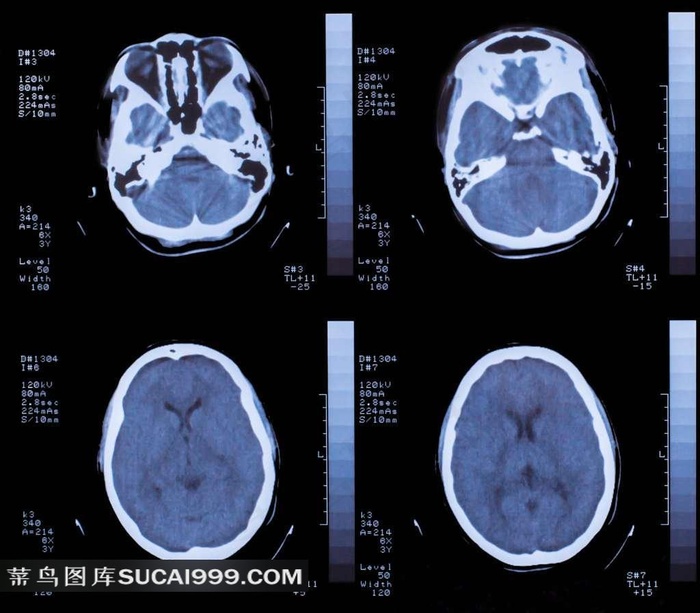 脑部核磁共振光片图