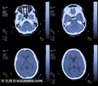 脑部核磁共振光片图