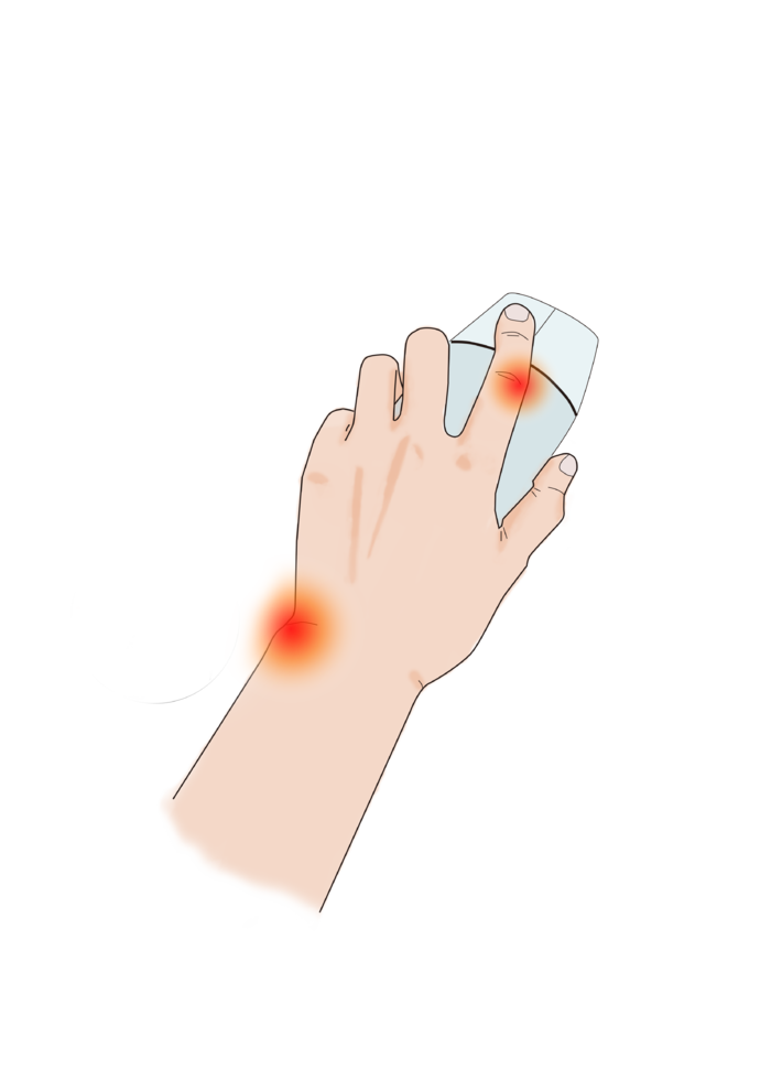 手部疾病鼠标手
