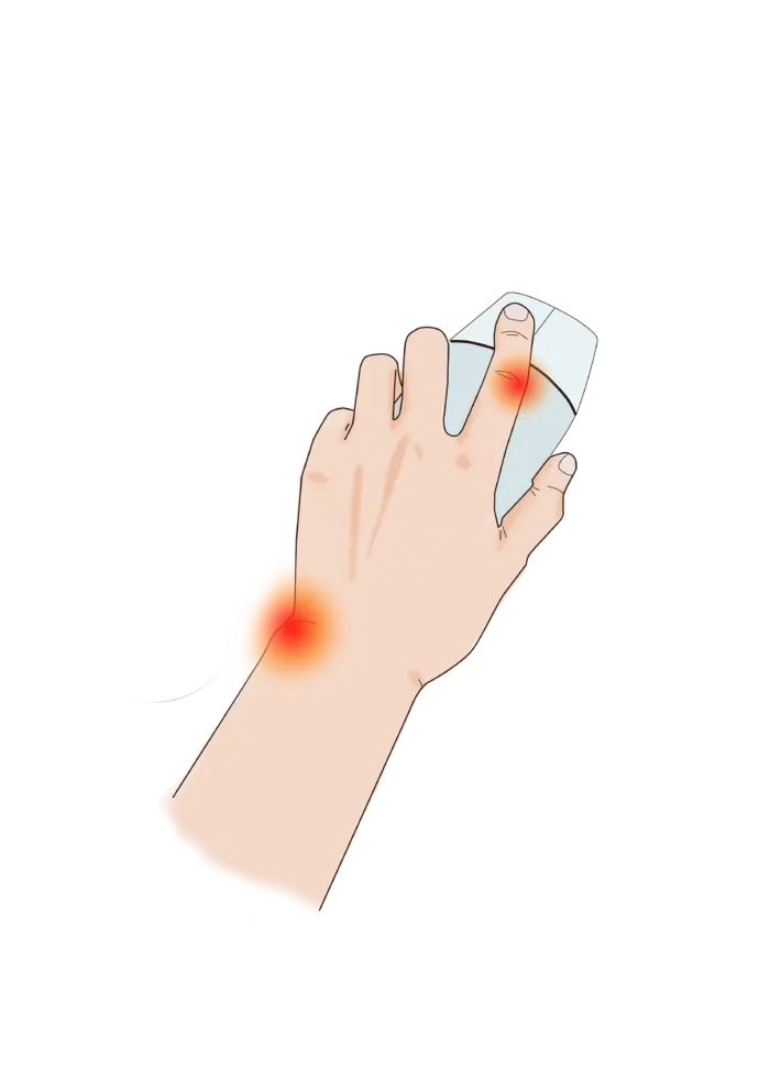 手部疾病鼠标手