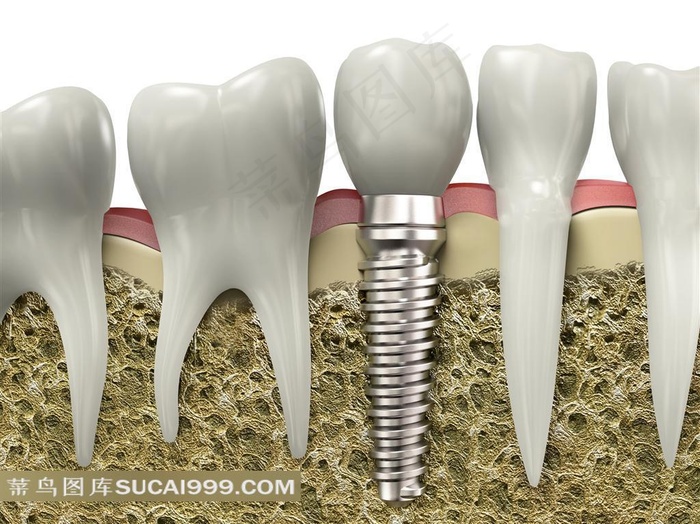 高清种植牙示意图