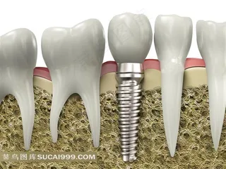 高清种植牙示意图