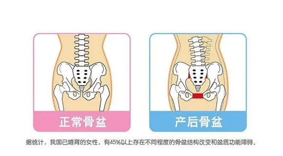 骨盆抠图正常骨盆产后骨盆对比