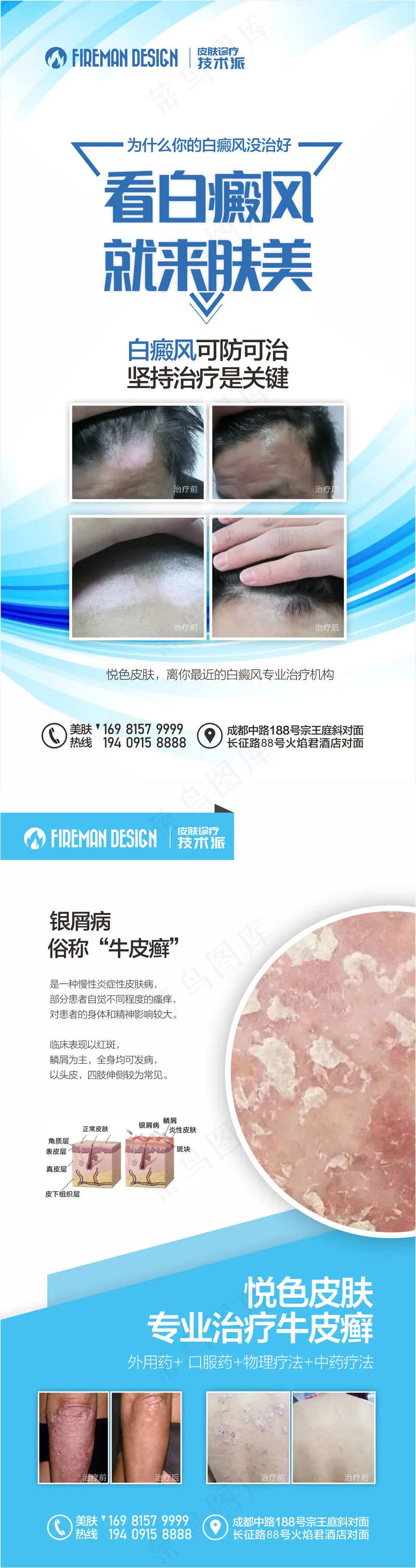 白癜风银屑病海报cdr矢量模版下载