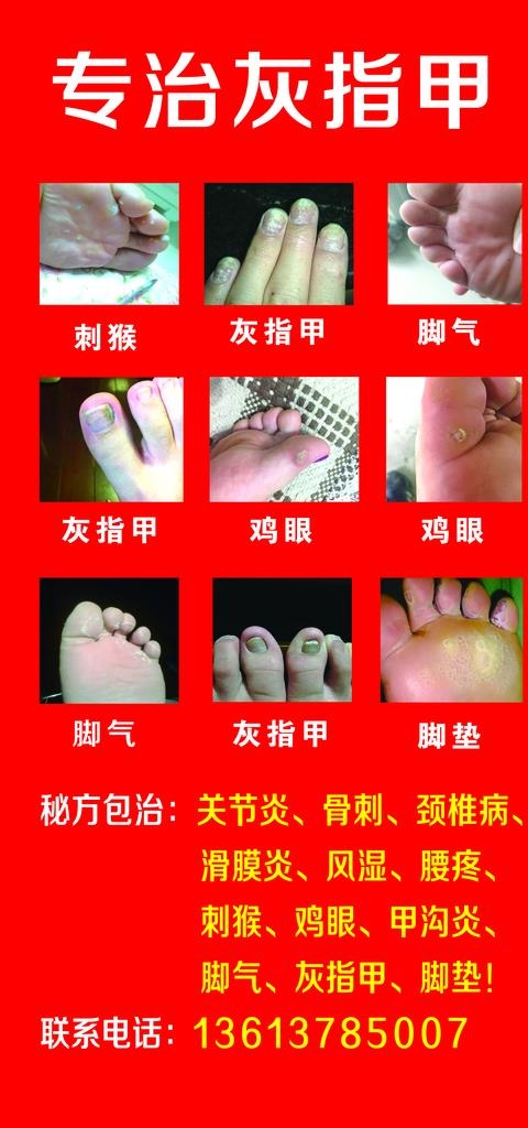 灰指甲海报图片