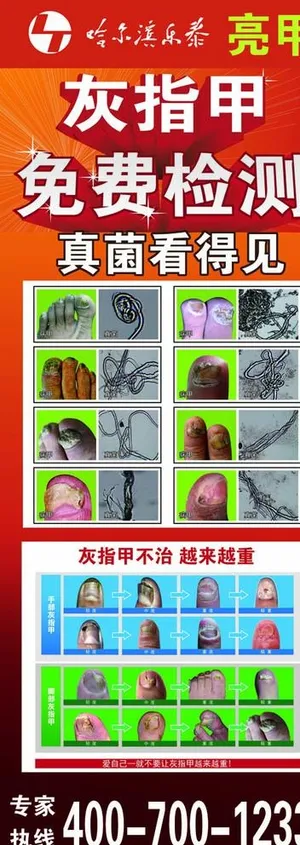 灰指甲海报图片