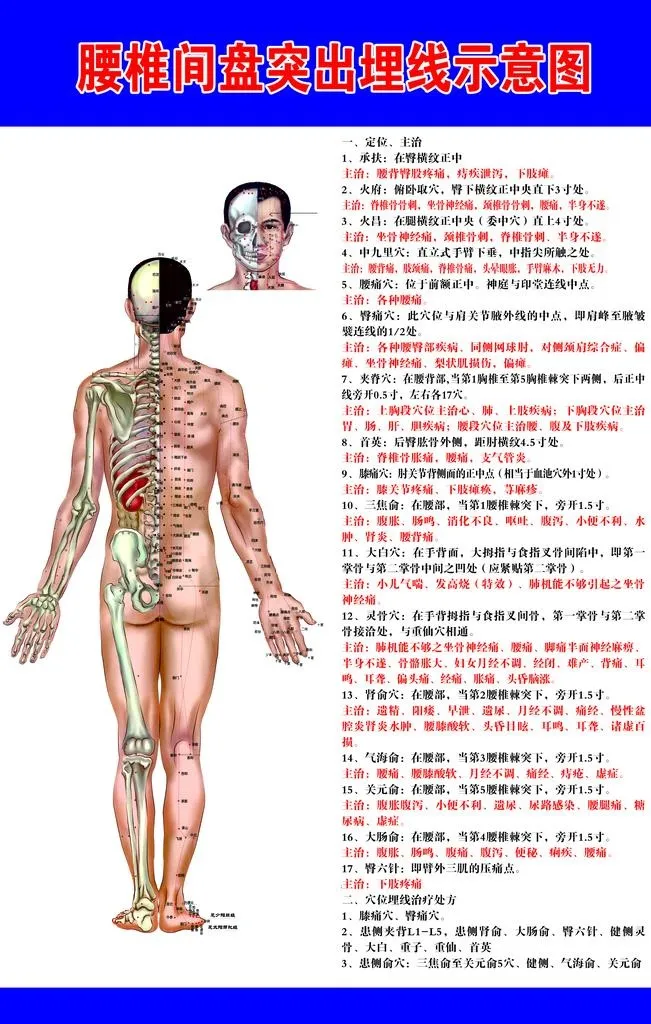 腰椎间盘突出埋线示意图图片(2362x3543)psd模版下载