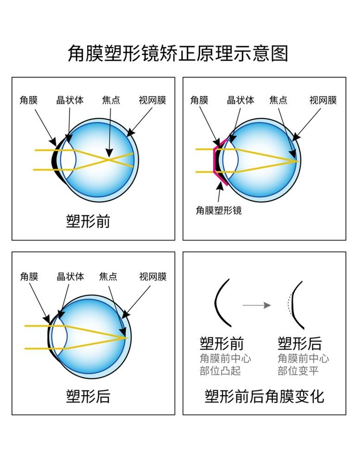 角膜塑形镜矫正原理示意图图片