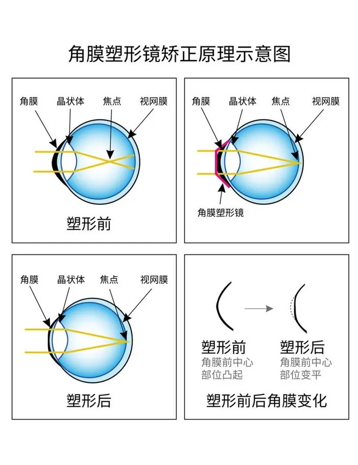 角膜塑形镜矫正原理示意图图片(4488x6000)psd模版下载