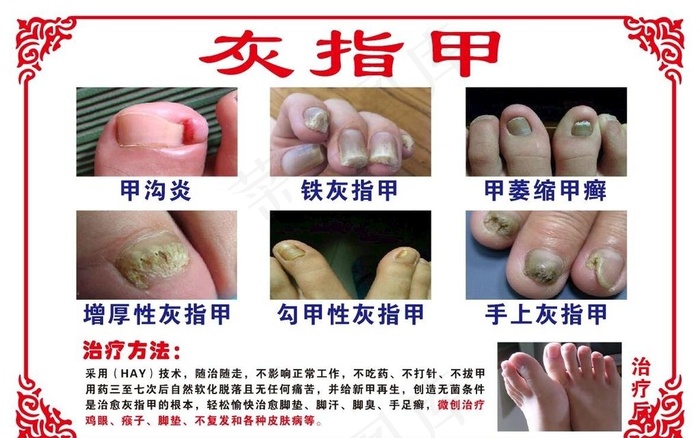 灰指甲图片
