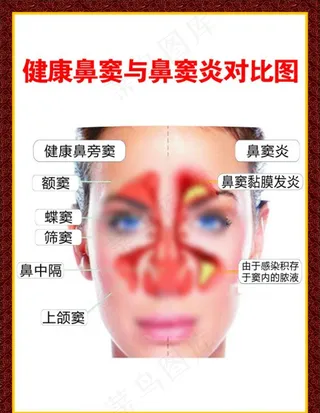健康鼻窦与鼻窦炎对比图图片