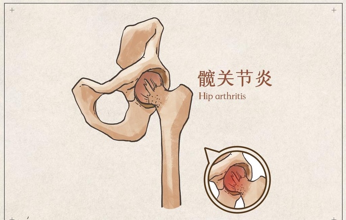 髋关节炎图片
