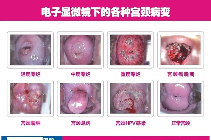 宫颈糜烂对比图图片