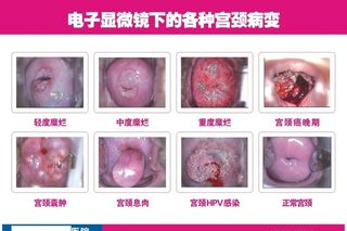 宫颈糜烂对比图图片