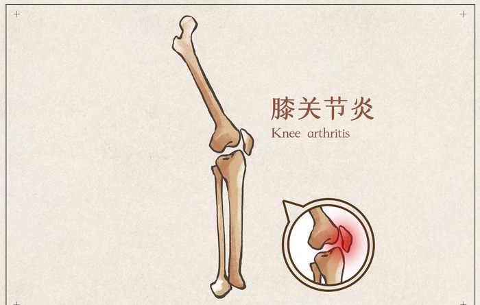 膝关节炎图片