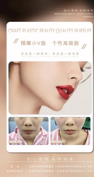 医美V脸案例打造图片