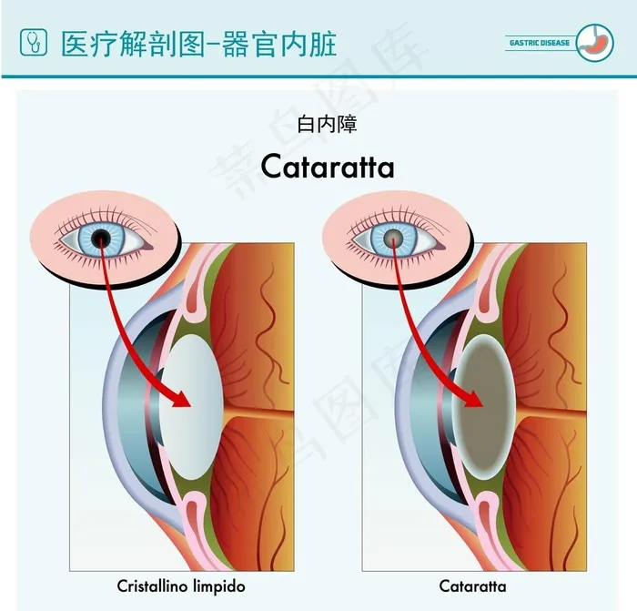 医疗白内障解剖图图片ai矢量模版下载