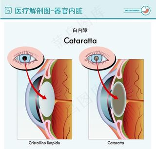 医疗白内障解剖图图片