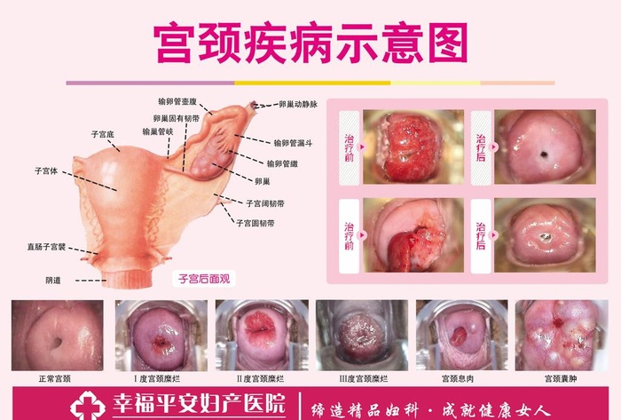 宫颈疾病示意图图片(3609x2551)psd模版下载