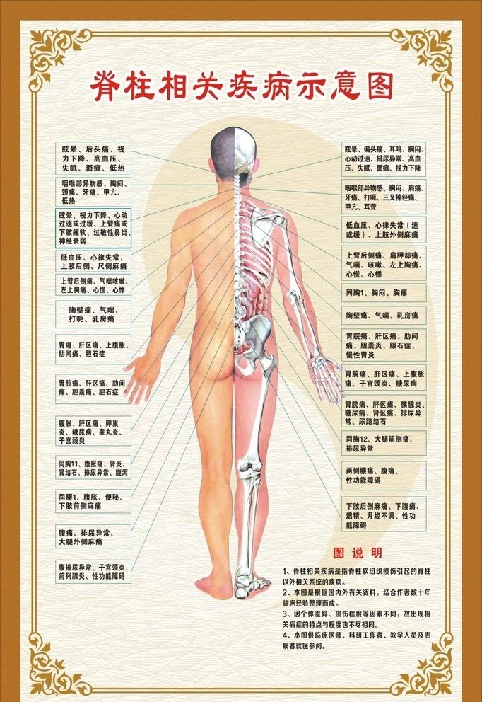 脊柱相关疾病示意图图片cdr矢量模版下载