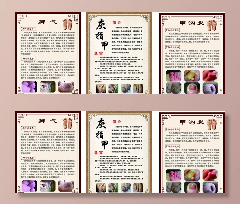 养生海报 灰指甲 甲沟炎 脚气图片cdr矢量模版下载