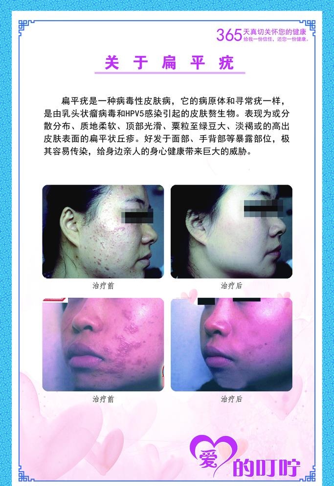 扁平疣展板图片